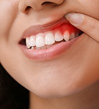 Woman lifting lip and showing signs of gum disease