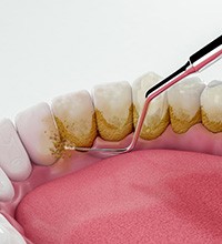 Illustration of scaling and root planing for lower arch