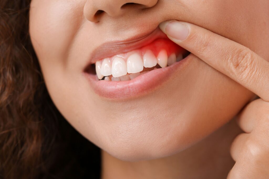 Nose-to-chin view of woman pulling back lip to reveal inflamed gums